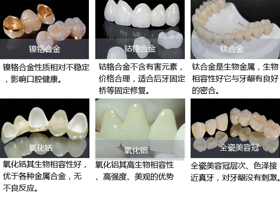 全瓷牙和贵金属哪个贵(全瓷牙和贵金属哪个贵一点)